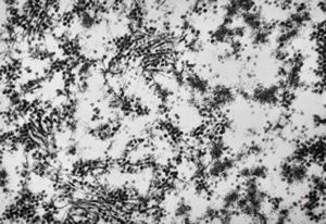 F,50y. | papilomavirus in glial cell - progressive multifocal leukodystrophy F,50y. | papilomavirus in glial cell - progressive multifocal leukodystrophy